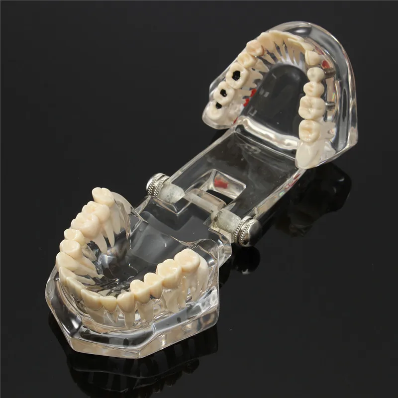 Dentalmodelle reparierbare Harzmodelle für erkrankten Zähne für den – Bild 6