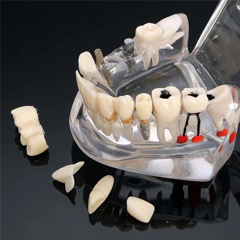 Dentalmodelle reparierbare Harzmodelle für erkrankten Zähne für den – Bild 5