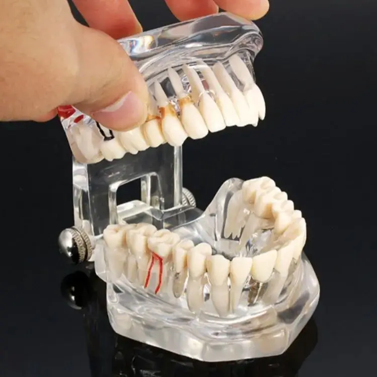 Dentalmodelle reparierbare Harzmodelle für erkrankten Zähne für den – Bild 2
