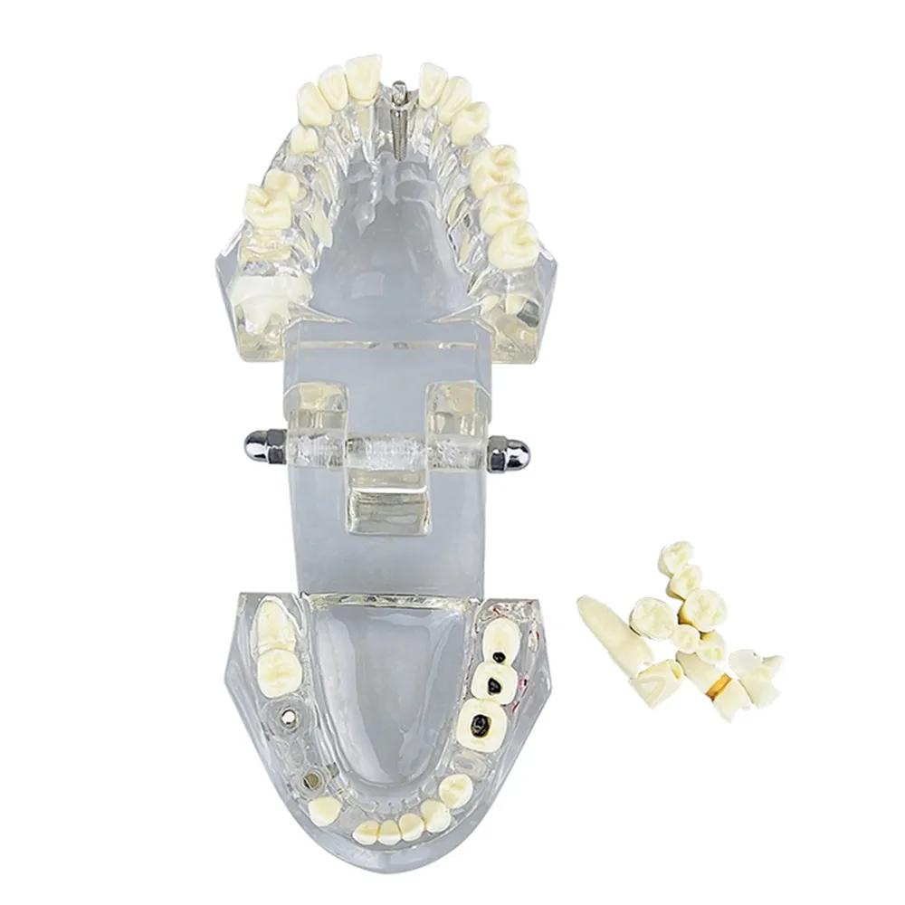 Zahn implantat Zahn reparatur modell mit Restaurierung brücke Lehr – Bild 4