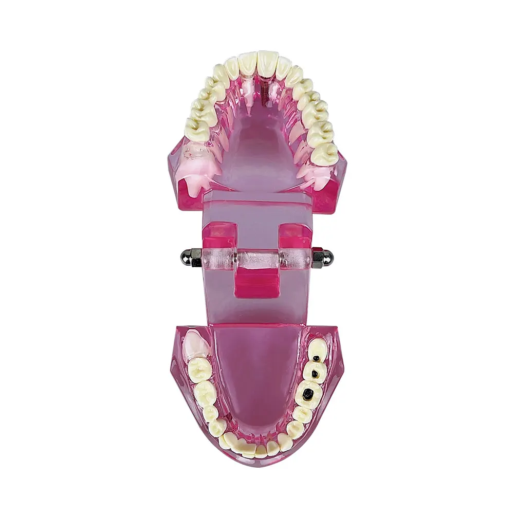 Zahn implantat Zahn reparatur modell mit Restaurierung brücke Lehr – Bild 2