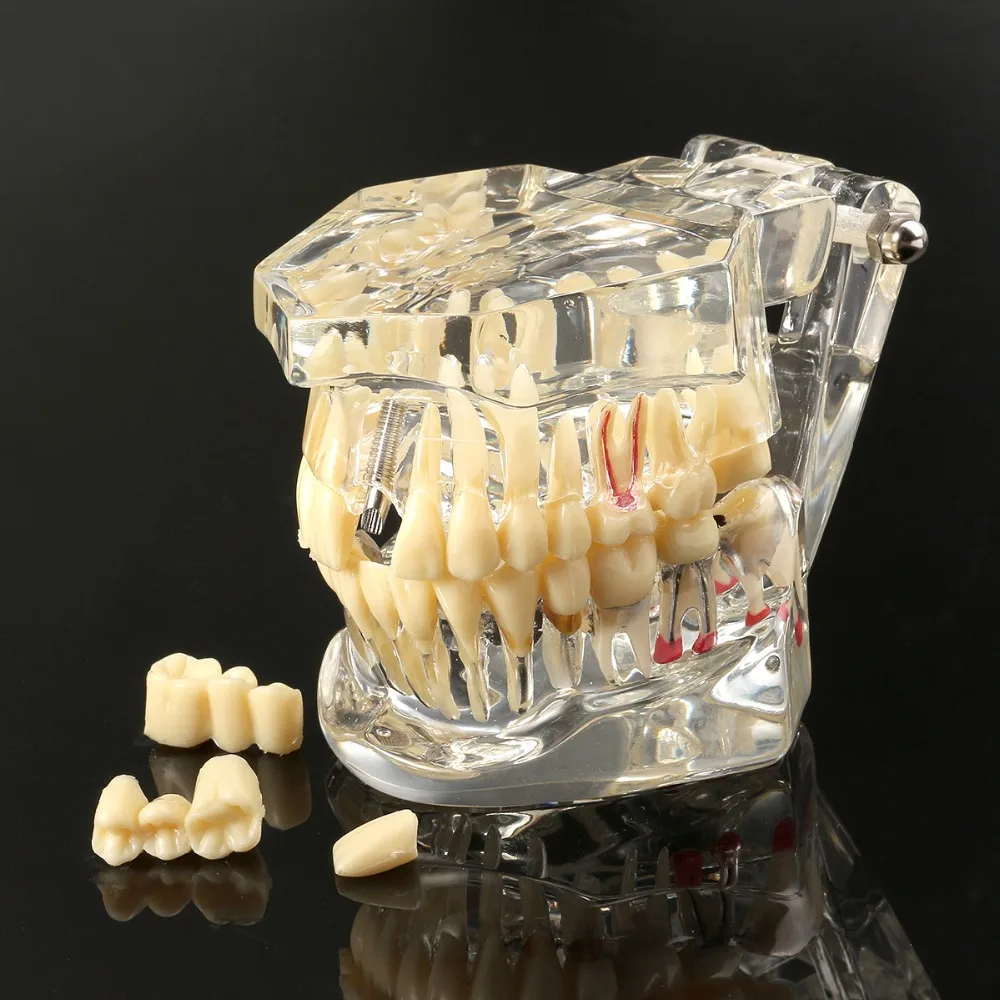 Dentalmodelle reparierbare Harzmodelle für erkrankten Zähne für den Unterricht und Forschung in Medizin