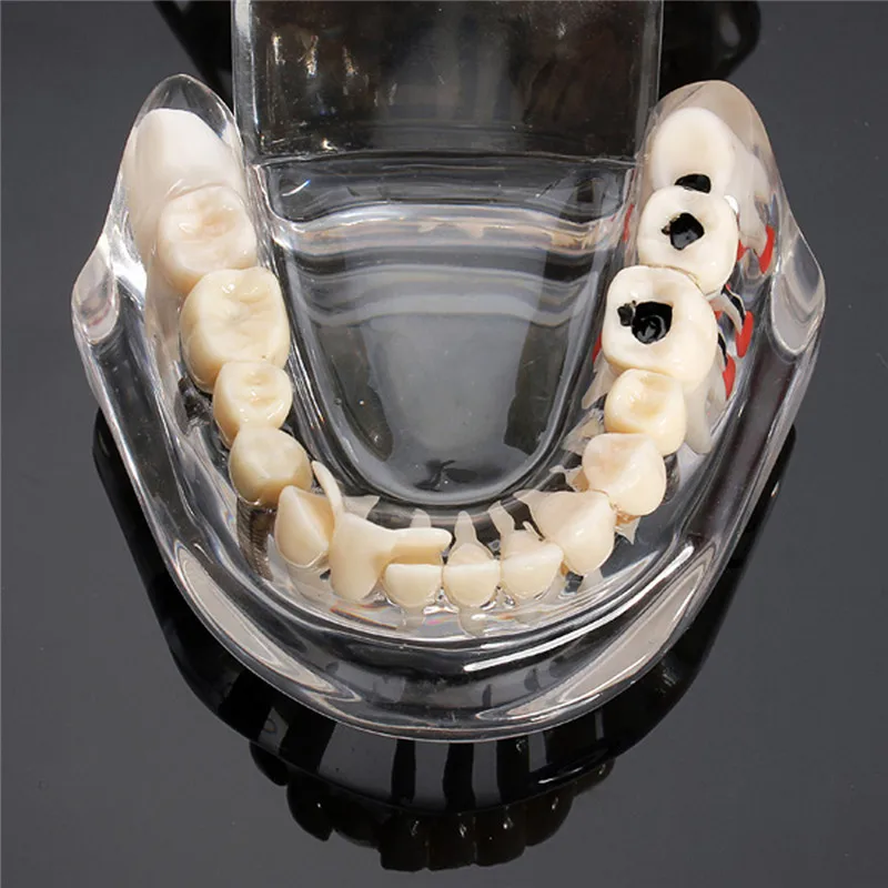 Dentalmodelle reparierbare Harzmodelle für erkrankten Zähne für den – Bild 4
