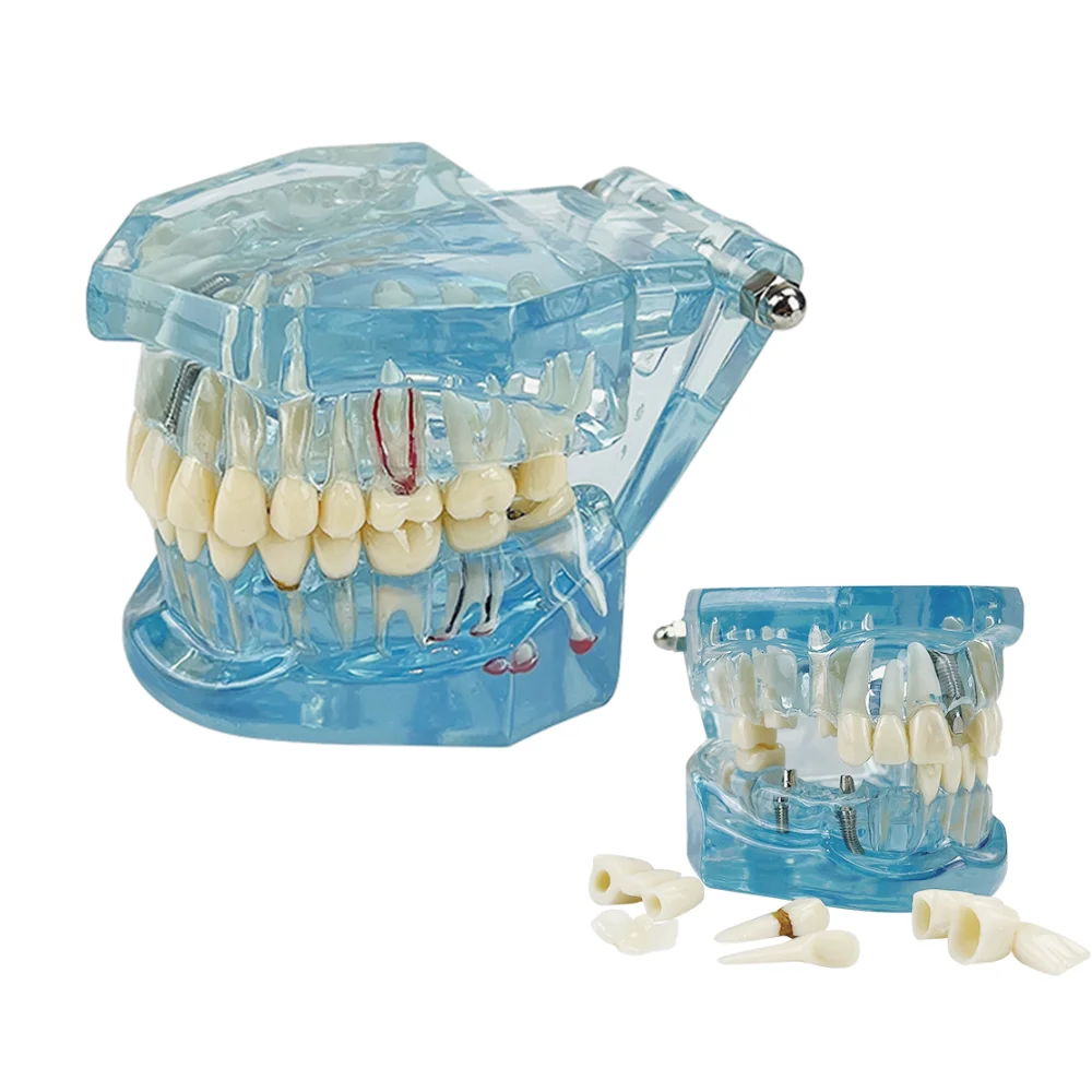 Zahn implantat Zahn reparatur modell mit Restaurierung brücke Lehr – Bild 5