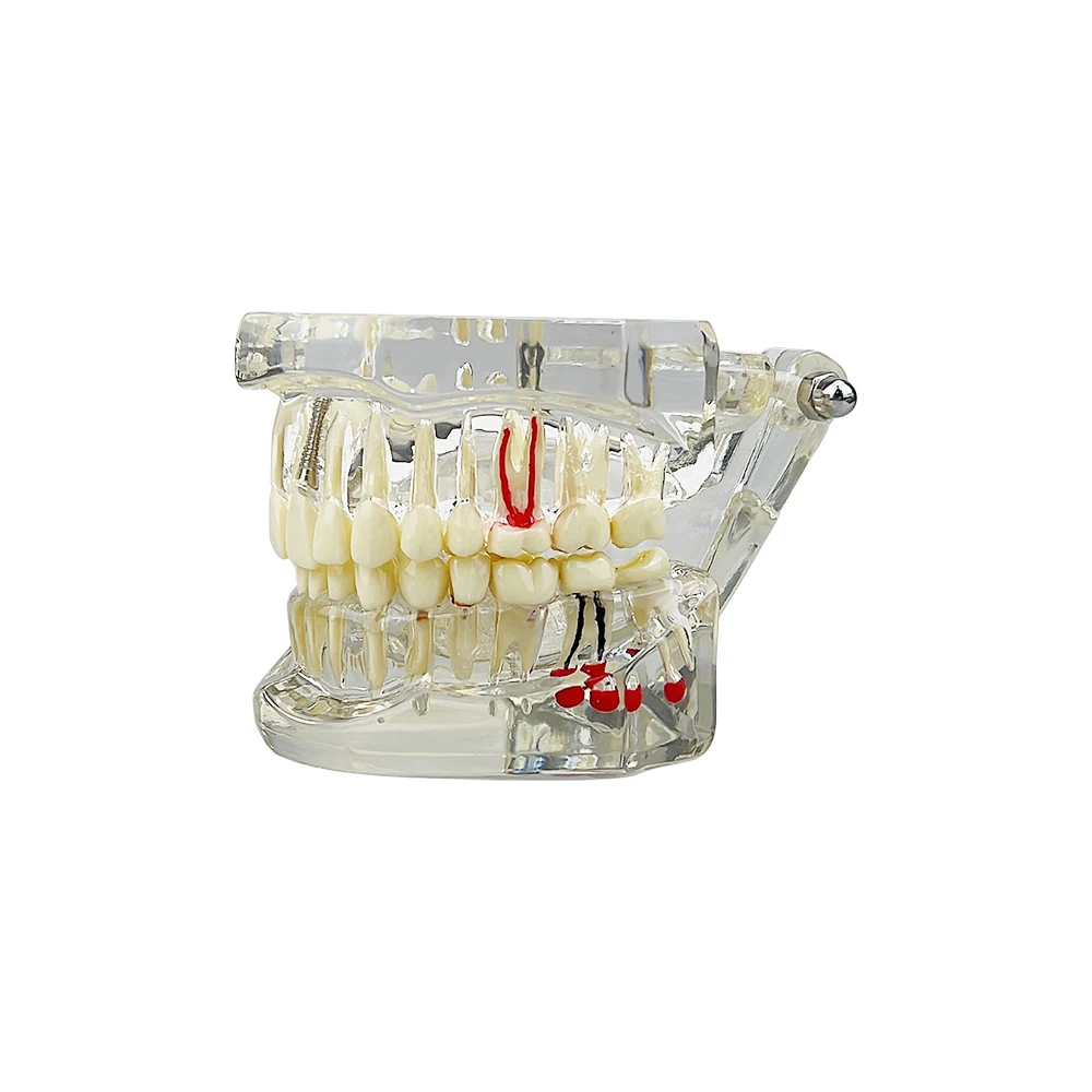 Zahn implantat Zahn reparatur modell mit Restaurierung brücke Lehr – Bild 3